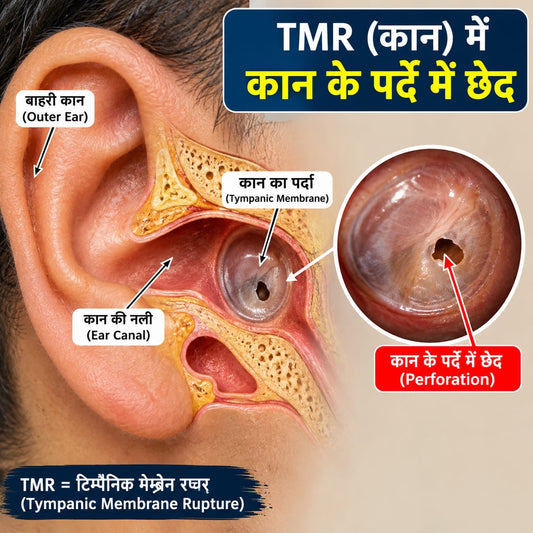 30 - Days Ear Treatment Kit-WITH ear drum perforation